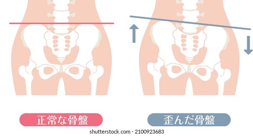 Human body (normal and distorted pelvis)

There is a description of "normal pelvis" and "distorted pelvis" in Japanese.