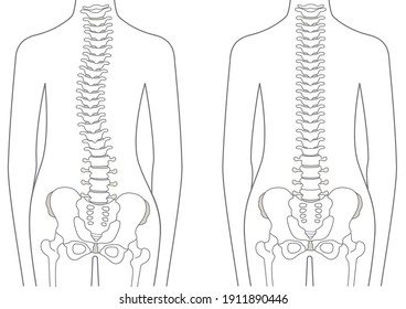 Human body Normal spine and distorted spine