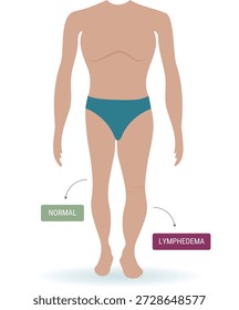 Cuerpo humano delineando la pierna normal en comparación con la pierna con síntomas de linfedema, mostrando hinchazón y retención de líquidos