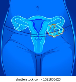 Human Body Ovarian Cancer