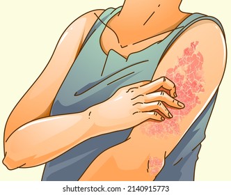 Human body with skin disease. Itching, scabies. Healthcare illustration. Vector illustration. 