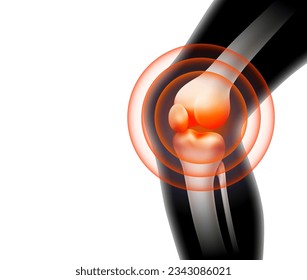 Human bone anatomy Inflammation of the knee joint. medical health, osteopathic hospitals. vector realistic illustration.