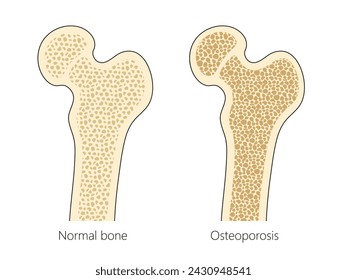 estructura ósea humana con diagrama de osteoporosis ilustración vectorial esquemática dibujada a mano. Ilustración educativa de ciencias médicas