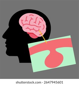 human brain with aneurysm condition useful for healthcare industry