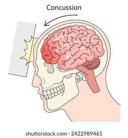 Human brain concussion structure diagram hand drawn schematic vector illustration. Medical science educational illustration