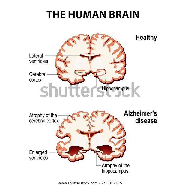 人間の脳 断面 アルツハイマー病の健康で脳 認知症 老衰 のベクター画像素材 ロイヤリティフリー