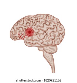 Human brain. Diseases of the brain, nervous system. Vector