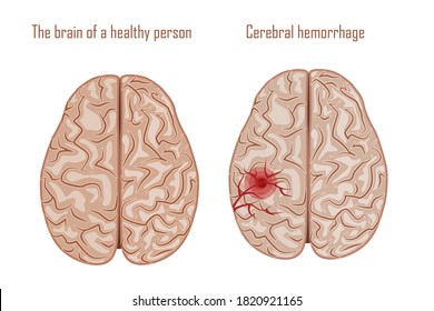 El cerebro humano. Enfermedades del cerebro, sistema nervioso. Vector
