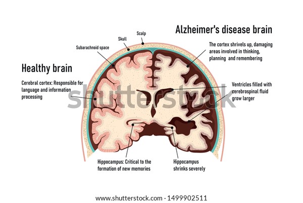 The Brain Of Alzheimer Images Stock Photos Vectors Shutterstock