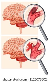 Human Brain And Hemorrhagic Stroke Illustration