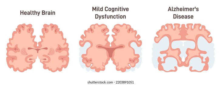 Human Brain MRI Scan. Healthy And Alzheimer's Disease Brain. Healthy Neuron And Neuron With Amyloid Plaques Cross Section Scan. Flat Vector Illustration