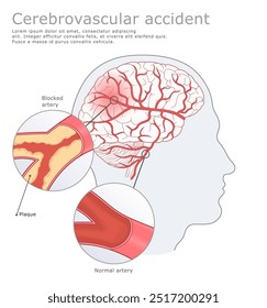 Cerebro humano con arteria normal y bloqueado. Ilustración vectorial médica por accidente cerebrovascular.
