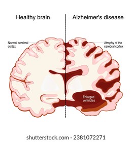 cerebro humano, en dos mitades: enfermedad sana y alzheimer. Sección transversal de un hemisferio cerebral. Ilustración del vector