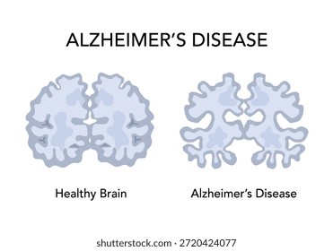 cerebro humano, en dos mitades: sano y enfermedad de Alzheimer. Neurona sana y neurona con placas amiloides. en comparación