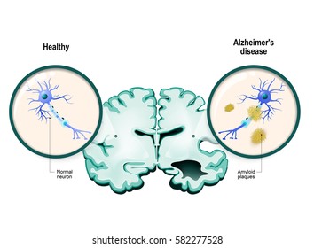 human brain, in two halves: healthy and Alzheimer's disease. Healthy neuron and neuron with amyloid plaques. in comparison