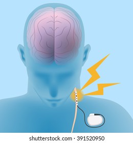 human brain and vagus nerve stimulation:VNS, image illustration