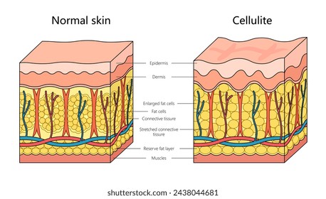 Human Cellulite Hautstruktur Diagramm Handgezeichnete schematische Vektor-Illustration. Medizin-Bildungs-Illustration