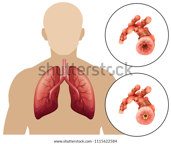 Human Chronic Obstructive Pulmonary Disease Illustration Stock Vector Royalty Free 1115622584