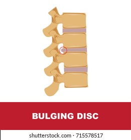 Human Disc Degeneration. Bulging Disc