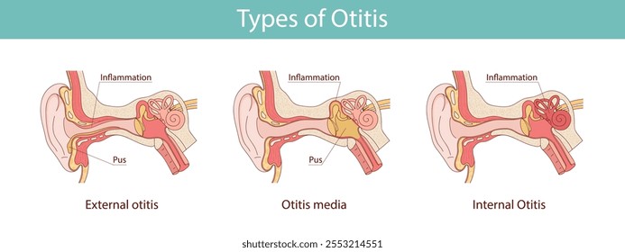 human ear inflammation. otitis disease vector medical illustration