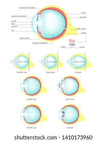 Human eye anatomy cross section medical diagram, vector flat isolated illustration. Structure of healthy eye and with glaucoma, cataract, hyperopia, myopia diseases and disorders.