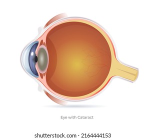 Human Eye with Cataract - Illustration as EPS 10 File