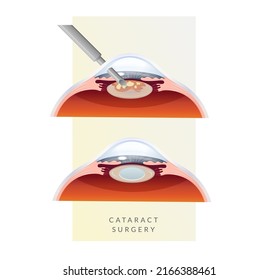 Human Eye - Cataract Procedure - Illustration as EPS 10 File