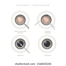 Human Eye - Cataract Procedure - Illustration as EPS 10 File svg