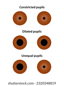 Human eye. Constricted, dilated, and unequal pupils.