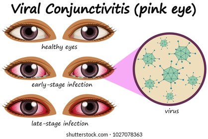 Human eye disease with viral conjunctivitis illustration