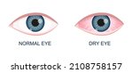 Human eye healthy and dry. Normal and inflamed bloodshot eyeball with irritation and red conjunctiva. Symptoms of keratitis, allergy, conjunctivitis, uveitis. Vector cartoon illustration.
