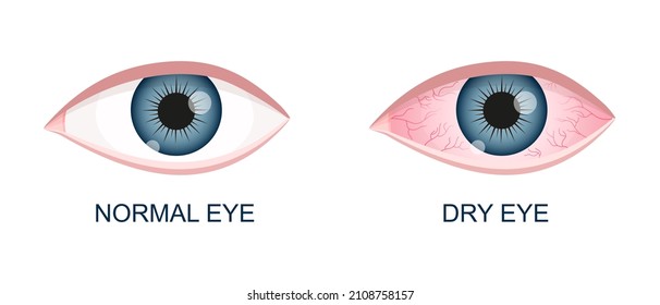 Human eye healthy and dry. Normal and inflamed bloodshot eyeball with irritation and red conjunctiva. Symptoms of keratitis, allergy, conjunctivitis, uveitis. Vector cartoon illustration.