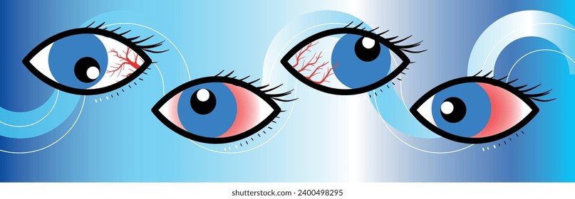 Ojo humano sano y seco. El globo ocular normal e inflamado con irritación y conjuntiva roja. Síntomas de queratitis, alergia, conjuntivitis, uveítis. Caricatura vectorial
