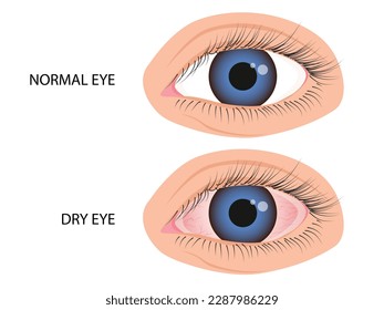 Human eye healthy and dry. Symptoms of keratitis, allergy, conjunctivitis, uveitis