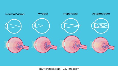 human eye Refractive Errors, Myopia, Hyperopia, Astigmatism, flat color illustration