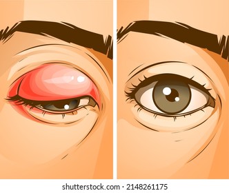 The human eye with the stye. Chalazion. Before, after. Healthcare problems. Medical illustration, vector illustration. 