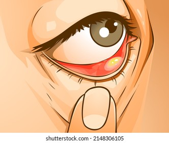 A human eye with the stye. Healthcare problems. Medical illustration, vector illustration. 