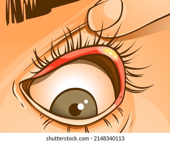 A human eye with the stye. Healthcare problems. Medical illustration, vector illustration. 