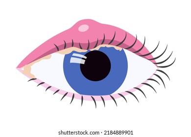 menschliches Auge mit geschwollenem Augenlider. Blepharitis. Augenbenentzündung medizinische Lustation.