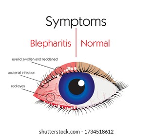 17 Nice Draw a sketch to describe blepharitis for Girl