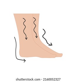 Hinchazón de pies y piernas humanos. Ilustración vectorial sobre el tema de la medicina