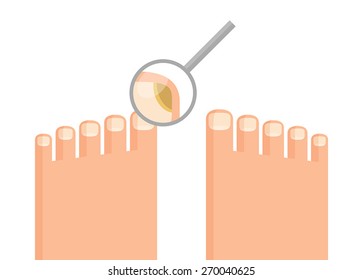 Human feet and magnifying glass, in which can be seen that toenail is struck by mycosis. Hygiene and health concept. Stylized drawing