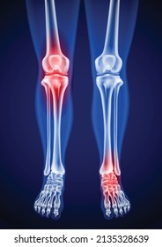 Human femur, knee and foot x-rays showing pain points in red for medical and educational use on a blue background.