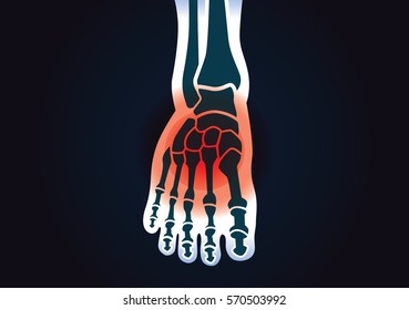 Human foot bone have a red signal. This illustration about foot pain.