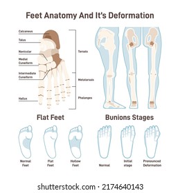 Human foot bones. Leg and foot step anatomical structure with captions, front view. Healthy skeleton scheme and foot deformities, bunions stages. Flat vector illustration