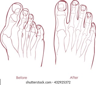 Human Foot Deformity. Hallux Valgus And Tailors Bunion.