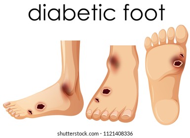 Human Foot with Diabetic  illustration