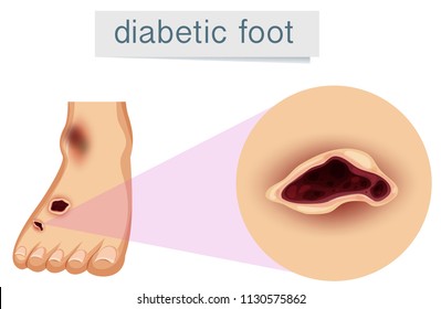 A human foot with diabetic  illustration