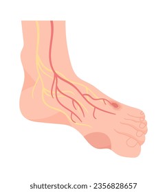 Human Foot Diseases Vector Illustration