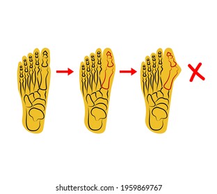 Human foot. Improper bone fusion. Symbol. Vector illustration.